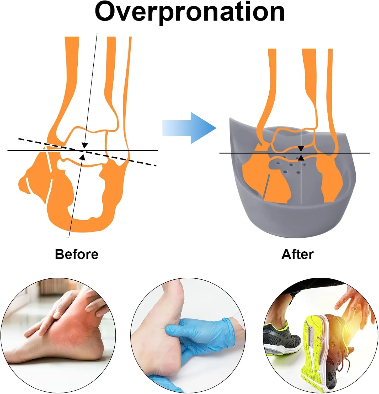 3/4 Original High Arch Inserts Firm Orthotics for Plantar Fasciitis Flat Feet Over-Pronation, Comfort Metatarsal Pad Support Insoles Relief Heel Spur Pain