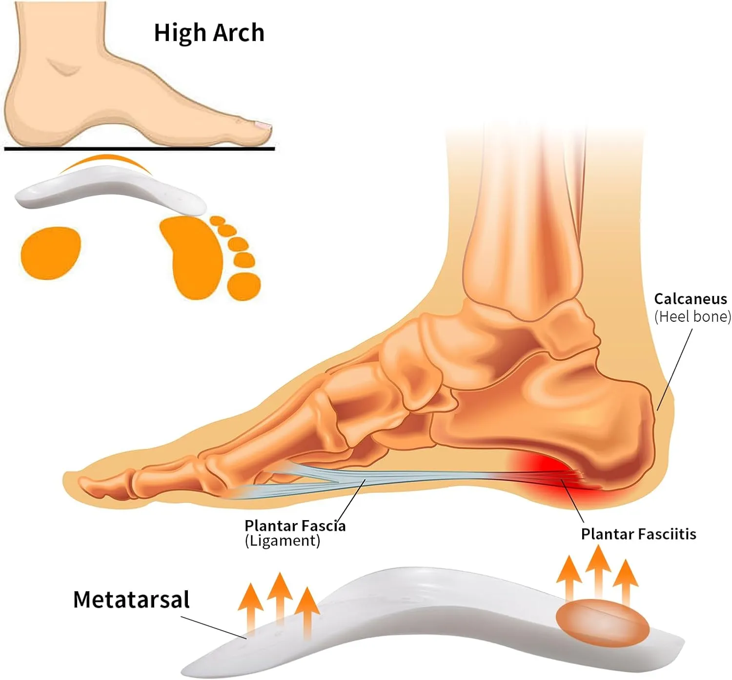 Original 3/4 Arch Support Metatarsal Support Orthotics Over-Pronation Insoles Relieve Plantar Fasciitis, Arch, Heel & Ankle Foot Pain (White, Men 9-12/Women 11-14)