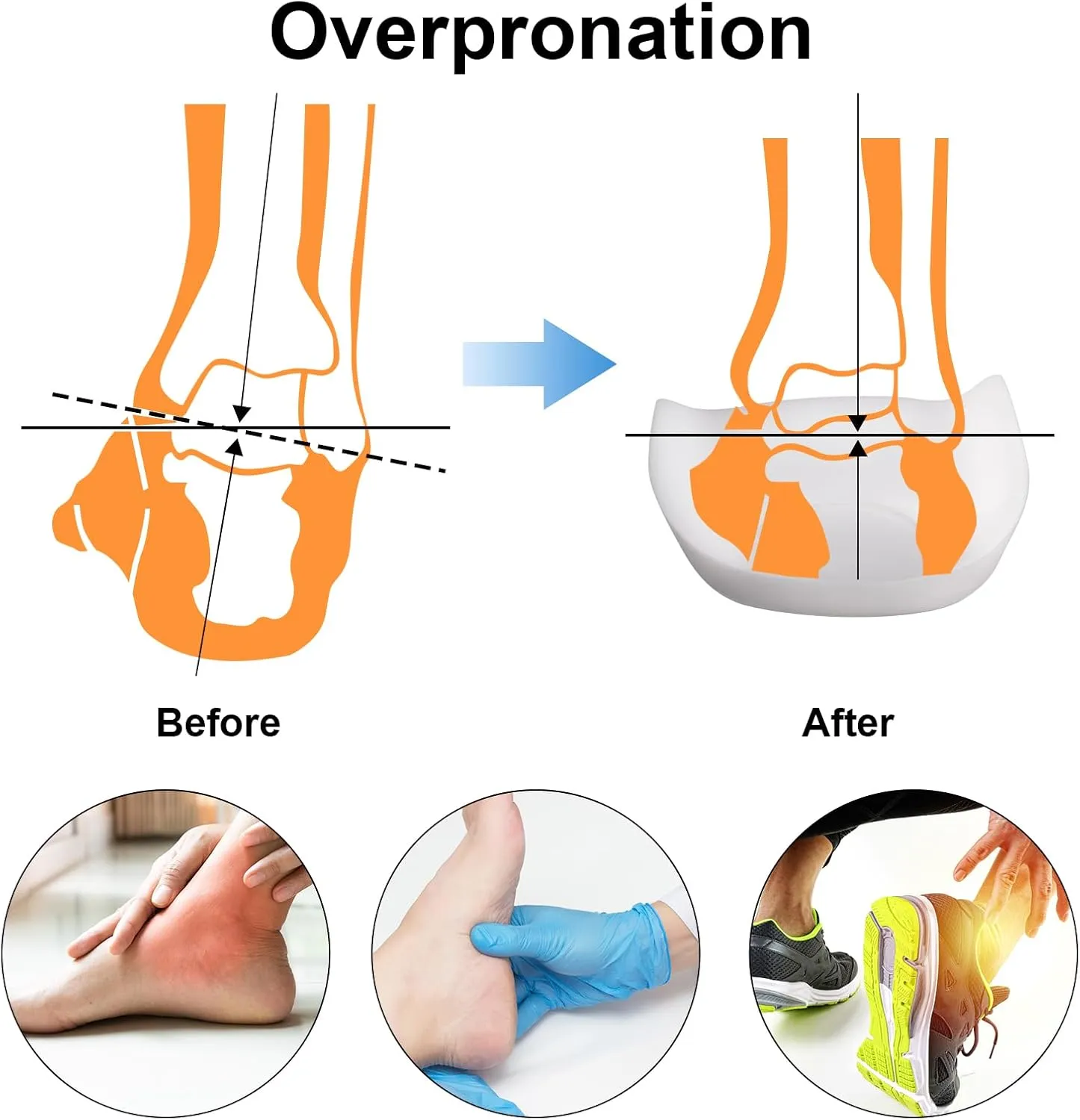 Original 3/4 Arch Support Metatarsal Support Orthotics Over-Pronation Insoles Relieve Plantar Fasciitis, Arch, Heel & Ankle Foot Pain (White, Men 9-12/Women 11-14)